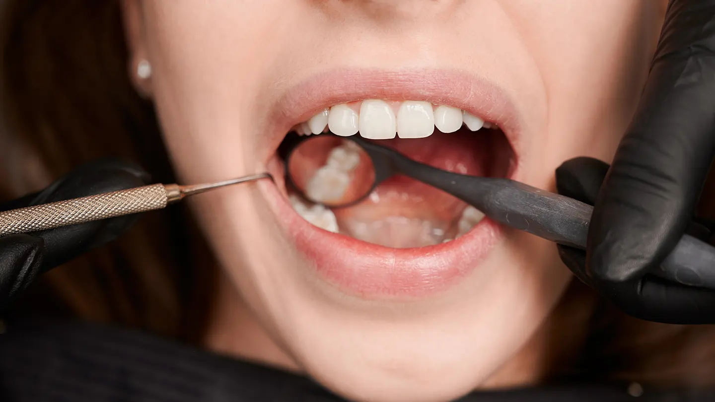 Diş Taşı Temizliği Nedir? Nasıl Yapılır?